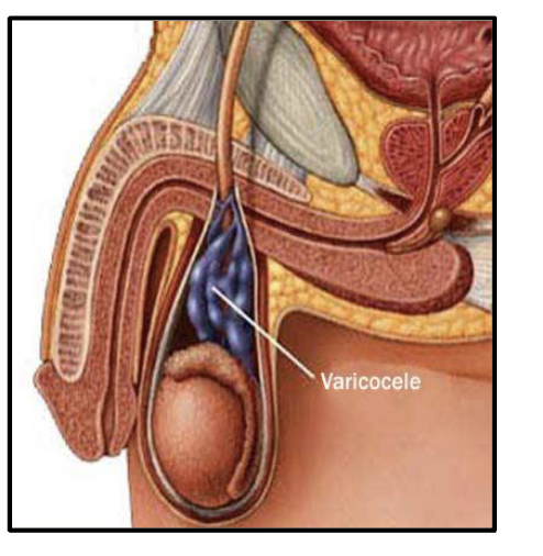 <ul><li><p>abnormal enlargement of the venous plexus of the scrotum (pampiniform plexus) which drains the testicles</p></li><li><p>cause:</p><ul><li><p>defective valves</p></li><li><p>compression of vein</p></li></ul></li><li><p>usually harmless but may affect infertility </p></li></ul><p></p>