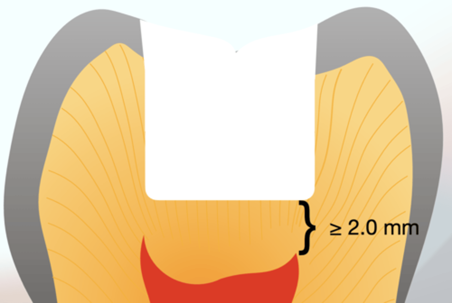 <p>greater than 2.0mm</p>