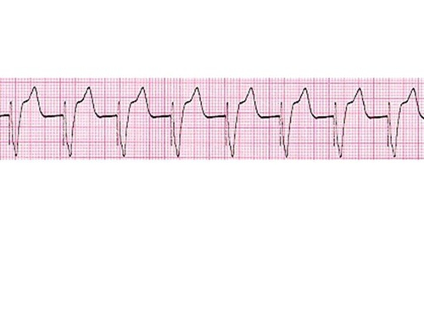 <p>Pacing is done within the ventricle. Firings are sent before the QRS.</p>