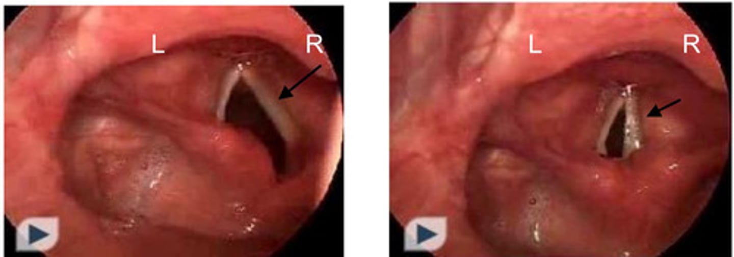 <p>*apparent when the one vocal cord doesn't abduct during forced inspiration</p>