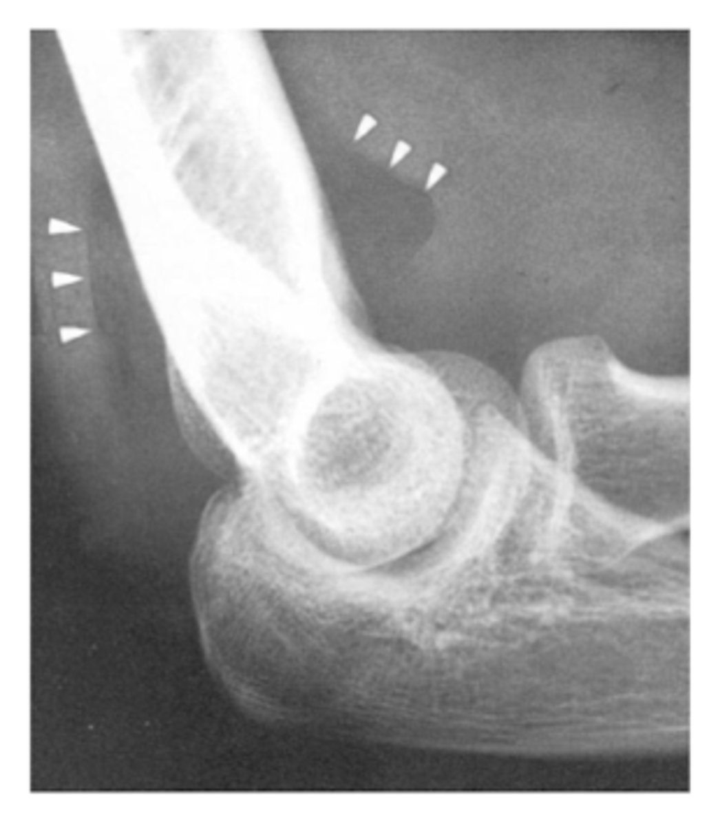 <p>presence an articular hemorrhage due to an occult or intra-articular fracture</p><p>Adults → radial head Fx</p><p>Children → supracondylar Fx of humerus</p>