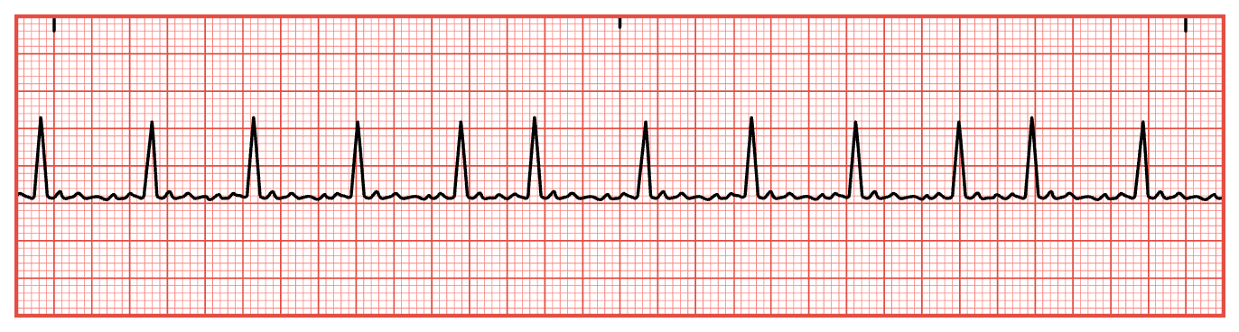 <ol type="1"><li><p><span style="font-family: &quot;Times New Roman&quot;;">Calculate heart rate.</span></p></li><li><p><span style="font-family: &quot;Times New Roman&quot;;">Determine if heart rhythm is regular.</span></p></li><li><p><span style="font-family: &quot;Times New Roman&quot;;">Assess for P waves.</span></p></li><li><p><span style="font-family: &quot;Times New Roman&quot;;">Measure PR interval.</span></p></li><li><p><span style="font-family: &quot;Times New Roman&quot;;">Measure duration of QRS complex.</span></p></li></ol><p></p>