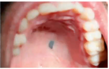 <p>what is the diagnosis of this blue/grey lesion </p>