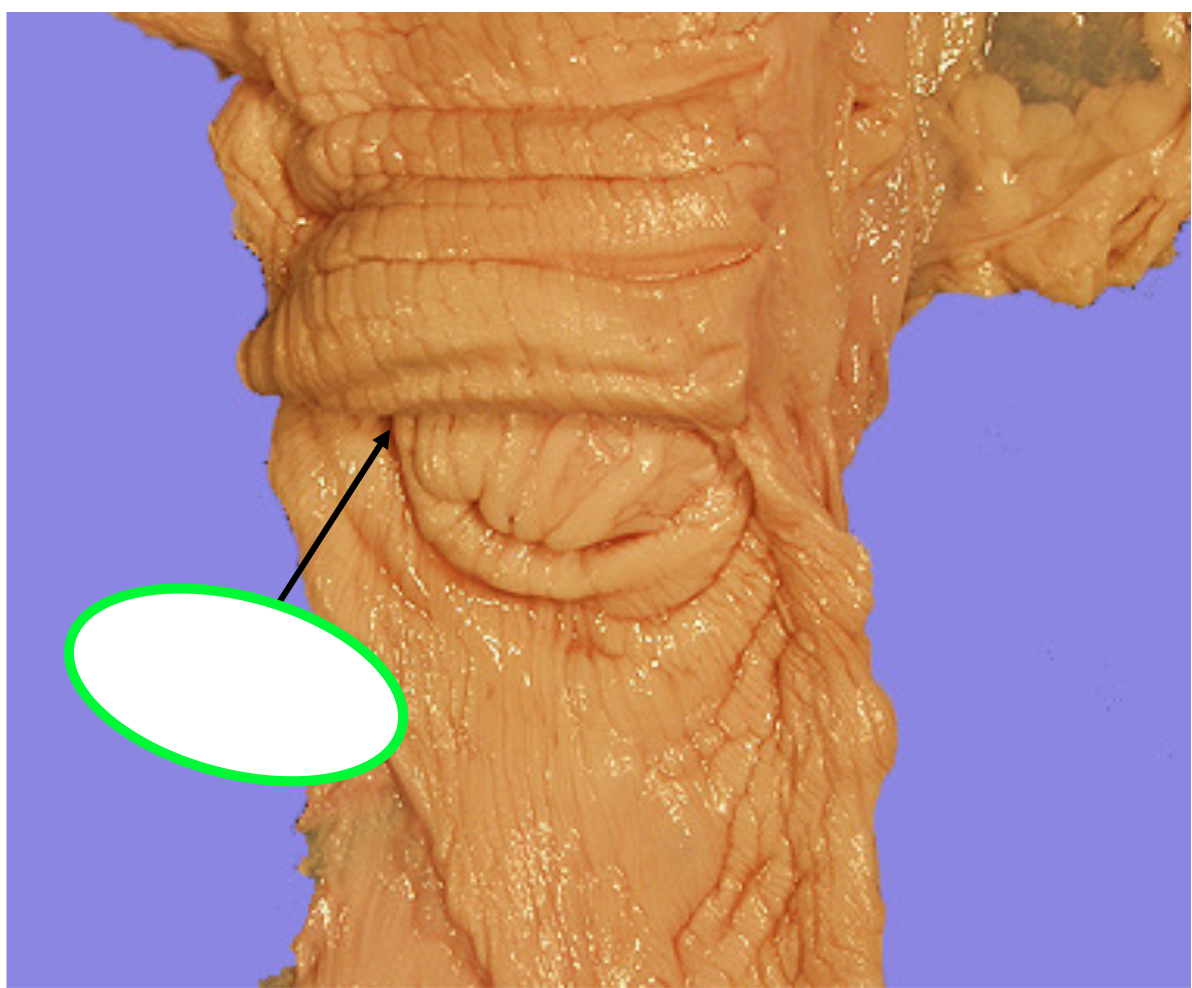 GREEN- depression around the muscular cervix