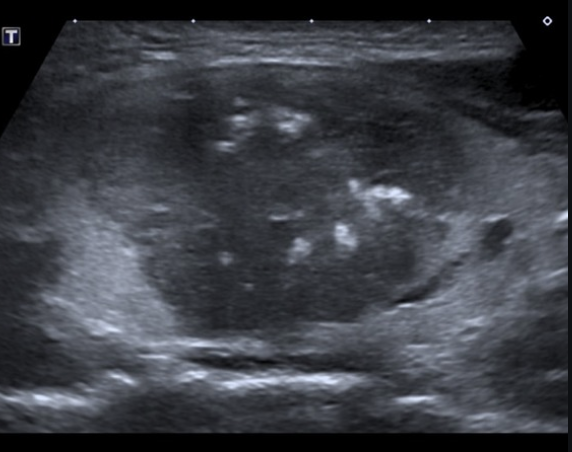 <p>What type of thyroid nodule is this - 4% of thyroid cancers; arises from C cells (parafollicular cells), metastasizes early, and is associated with MEN 2?</p>