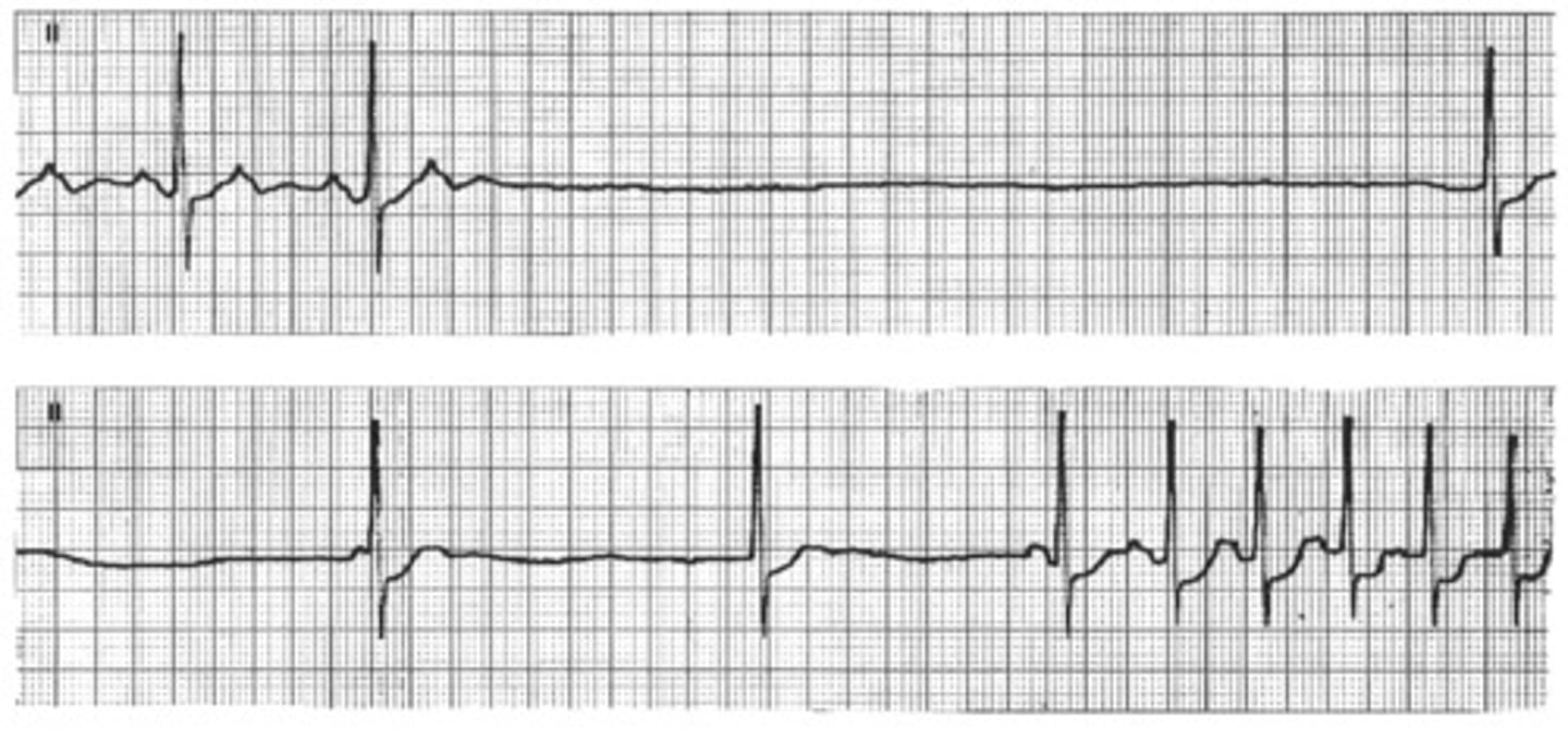 <p>"Wastebasket" of arrythmias caused by SA node dysfunction (often seen in the elderly due to replacement of sinus tissue with fibrous tissue); tachy-brady syndrome (alternating episodes of bradycardia &amp; tachycardia)</p>