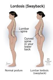 <p>what type of spinal curvature abnormality is this </p>