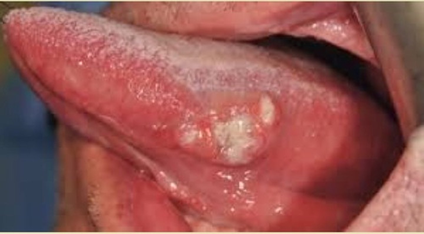 <p>non healing, mainly seen on the lateral border of the tongue</p>