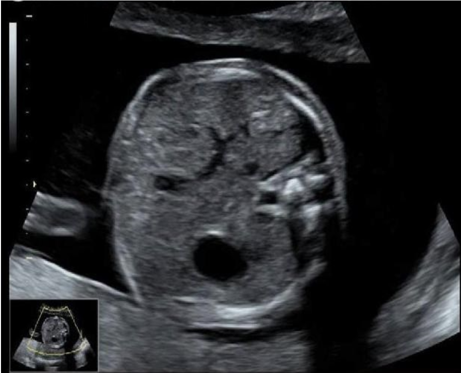 <p>what anatomic <strong>landmark</strong> makes it the proper location to perform an<strong> abdominal circumference </strong>measurement</p><p>.</p><p>a) duodenum</p><p>b) IVC</p><p>c) AO</p><p>d) portal vein</p>