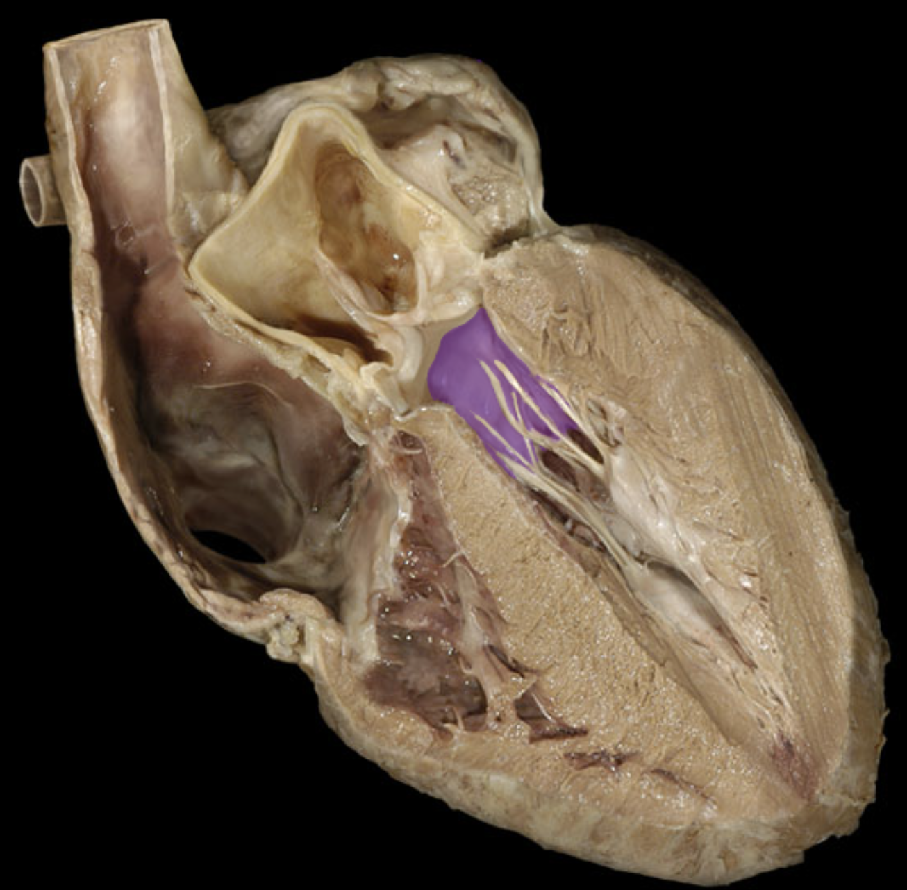 <p>Left atrioventricular valve</p>