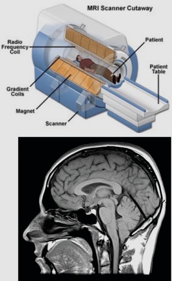<ul><li><p>It uses a strong magnetic field and low energy radio waves </p></li><li><p>The magnet causes every hydrogen proton in the body to spin in a particular direction </p></li><li><p>A pulse of low energy radio waves changes the spin of these protons. Then, each proton flips back to the spin direction determined by the magnet. During this, every proton emits a new radio waves changes, which is detected by the scanner</p></li><li><p>The scanner provides an estimate of the relative density of hydrogen atoms </p></li><li><p>MRI identifies the density of water molecules and fat molecules</p></li><li><p> High resolution three dimensional image </p></li></ul><p></p>