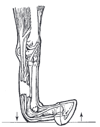 <ul><li><p><span>Complete loss of support of the MCP/MTP joint which is hyperextended to the extent that the MCP/MTP joint contacts the ground during the stance phase</span></p></li></ul>