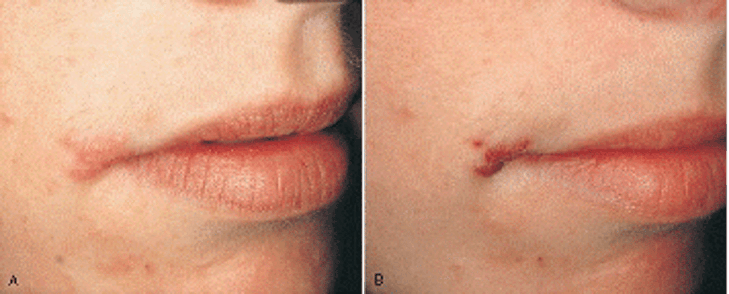 <p>Herpes Labialis</p>
