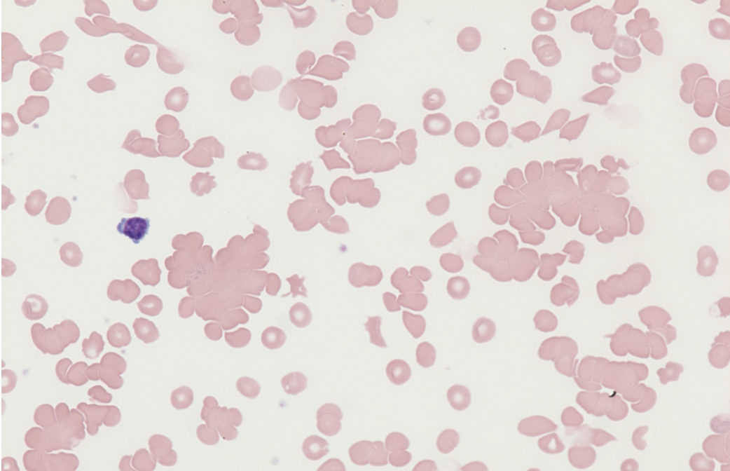 <p>what disease/condition is associated with agglutinated RBCs?</p>