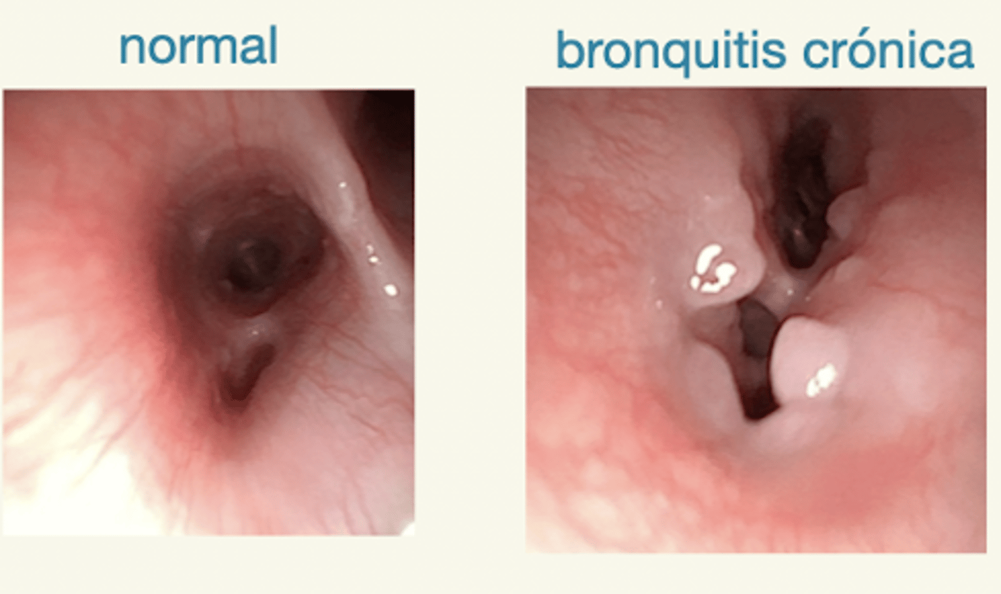 <p>mucosa irregular, sin aparencia brillante, hiperemia, colapso parcial de los bronquios</p>
