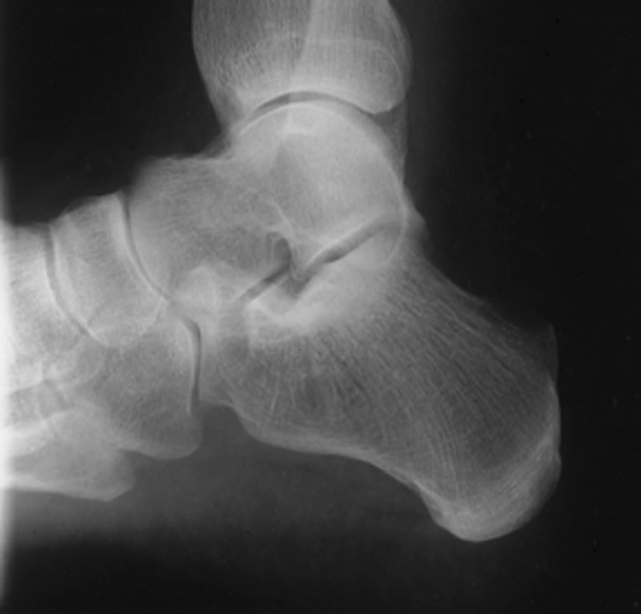 <p>- CR 1 inch (2.5 cm) inferior to medial malleolus</p><p>- Calcaneus and talus visualized</p><p>- No rotation</p><p>- Optimal exposure factors</p>