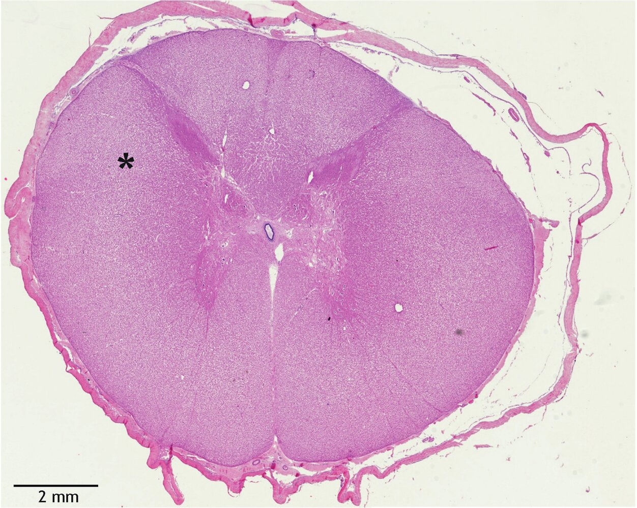 <p>63. Spinal cord injuries can lead to various neurological deficits due to damage to ascending and descending nerve tracts.</p><p>Which of the following tracts is most likely located in the area of white matter marked by the asterisk (*) in the image?</p><p>A. Fasciculus cuneatus</p><p>B. Fasciculus gracilis</p><p>C. Lateral corticospinal tract (Tractus corticospinalis lateralis)</p><p>D. Posterior spinocerebellar tract (Tractus spinocerebellaris posterior)</p><p>E. Lateral spinothalamic tract (Tractus spinothalamicus lateralis)</p>