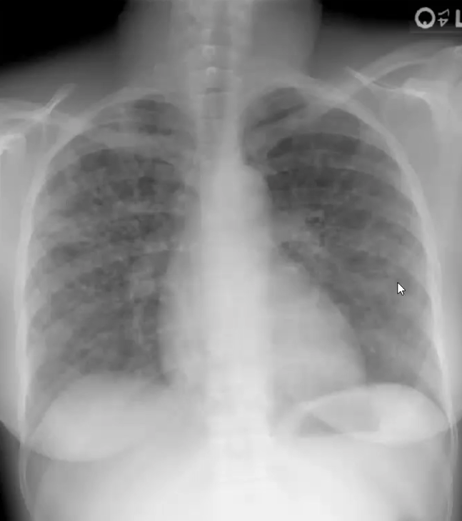 <ul><li><p>Systemic Disease</p></li><li><p>Unknown Etiology, said to be caused by <strong>dysregulated T cell response</strong> to the environment, viruses, bacteria, etc.</p></li><li><p><strong>Bilateral hilar lymphadenopathy</strong>, <strong>non-caseating granulomas</strong> in multiple organs, giant cells can be seen on microscope within the epithelioid granulomas → dyspnea, <strong>diffuse interstitial fibrosis</strong> and pulmonary hypertension, <strong>hypercalcemia and hypercalciuria, Langerhans cells have asteroid bodies</strong></p></li></ul><p></p>