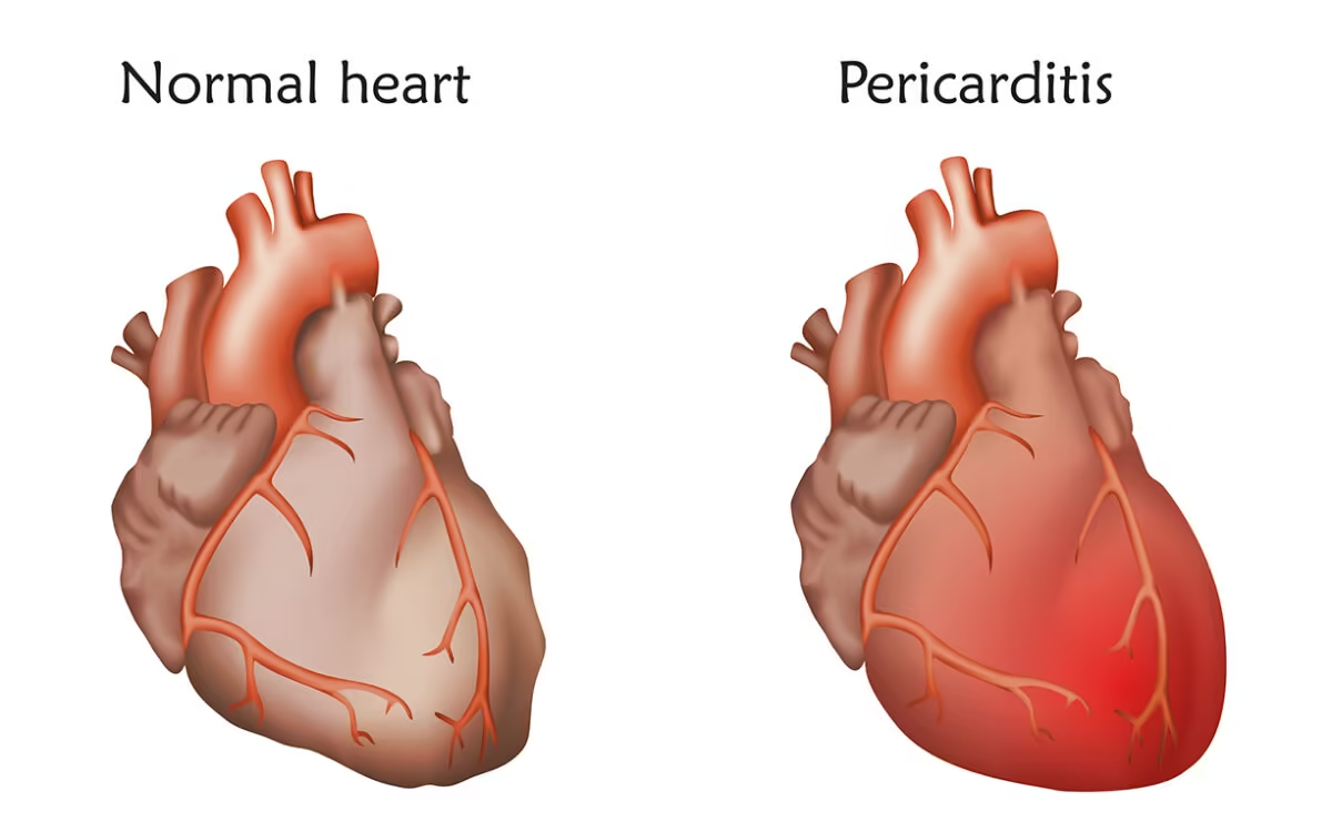 <p>Inflammation of the pericardial sac around the heart.</p>