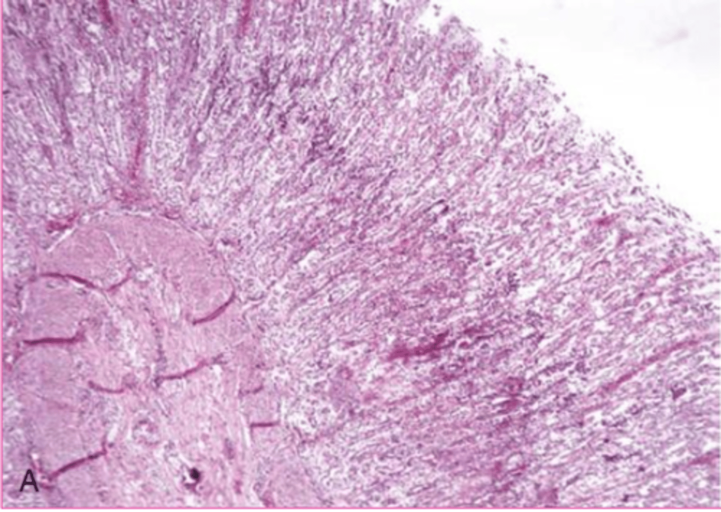 <p>Describe this extracellular accumulation?</p>