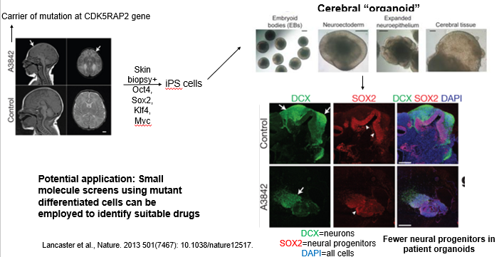 <p>Microcephaly is a neurodevelopmental disorder caused by various autosomal recessive mutations (e.g in the CDK5RAP2 gene), infants are born with an abnormally small brain and it leads to neurological defects and seizures. Mouse mutants have failed to recapitulate the condition. Here is an example of using iPSCs to provide a powerful "disease-in-a-dish" platform. </p><p>The workflow is:</p><ol><li><p><strong>Biopsy &amp; Reprogramming:</strong> Take a skin biopsy from a patient with a known genetic disorder (e.g., a mutation in the CDK5RAP2 gene causing microcephaly). Reprogram these cells into patient-specific iPSCs using reprogramming factors (aka the Yamanaka factors (Oct4, Sox2, Klf4, c-Myc)).</p></li><li><p><strong>Differentiation:</strong> Differentiate both patient and healthy control iPSCs into the affected cell type. For microcephaly, this was done by generating cerebral organoids.</p></li><li><p><strong>Phenotype Analysis:</strong> Compare the patient-derived model to the control. In the microcephaly study, the patient organoids were smaller and had significantly fewer neural progenitors (SOX2+ cells), successfully recapitulating the key disease phenotype.</p></li><li><p><strong>Application:</strong> These patient-specific models can be used in high-throughput screens to test thousands of small molecules to identify drugs that can correct the cellular defect, paving the way for personalized medicine.</p></li></ol><p></p>