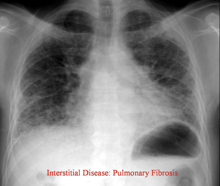 <p>Reticulonodular </p>