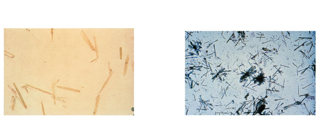 <p><span>Ampicillin crystals appear as colorless</span></p><p><span>needles that tend to form bundles following</span></p><p><span>refrigeration</span></p><p></p><p><span>Extreme dehydration</span></p>