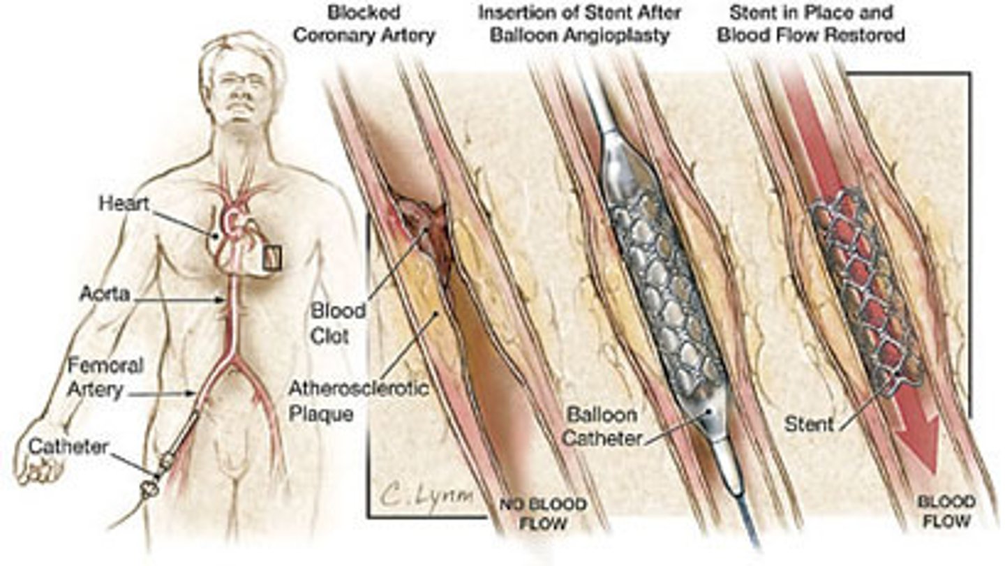 <p>percutaneous coronary intervention (PCI)<br><br>*an umbrella term</p>