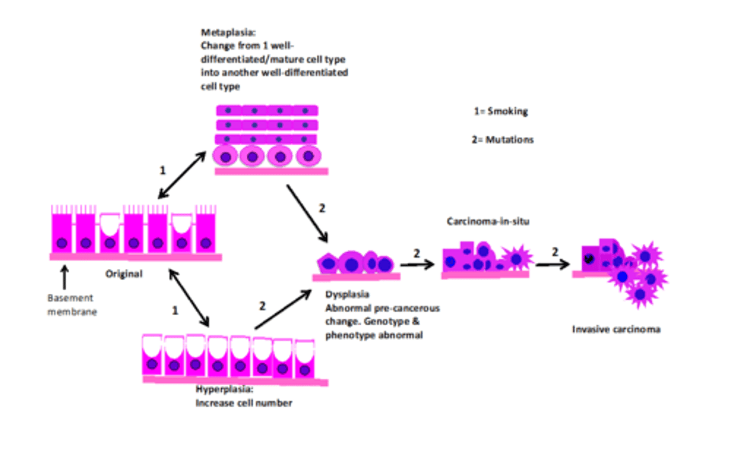 <p>Cilia --> Metaplasia --> Stratified squamous --> Dysplasia --> Squamous cell carcinoma</p><p>Goblet cell --> Hyperplasia (produce more mucus) --> Secretory Epithelium --> Dysplasia --> Adenocarcinoma</p>