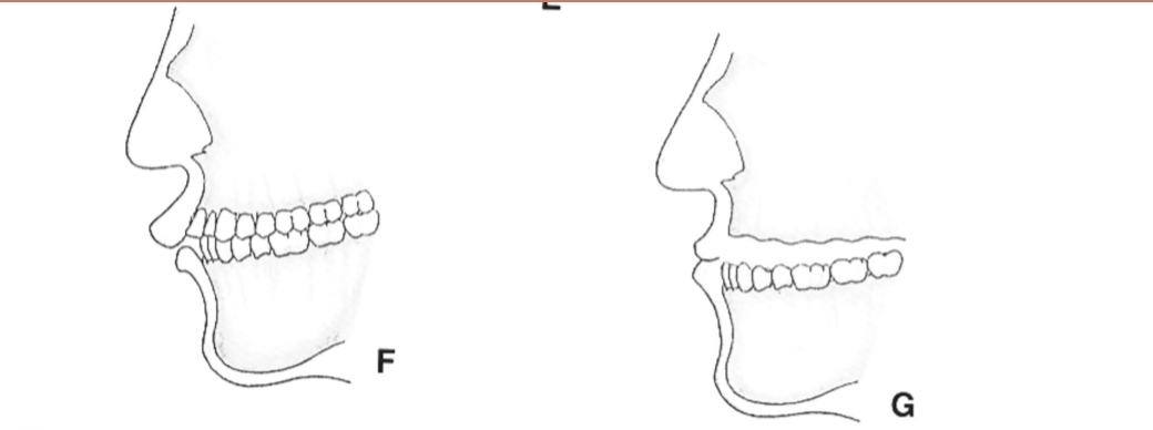 <p>Radical contouring of alveolar ridge to correct large horizontal discrepancy between jaws (that has caused protrusion, overjet etc)</p>