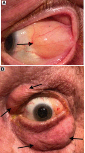 <p>1. Intraconal - subconjunctival herniated orbital fat<br>2. Extraconal fat prolapse</p>
