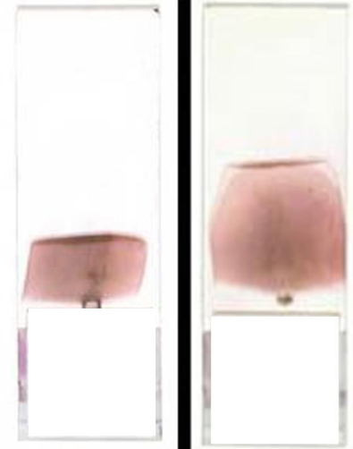 <p>What is this blood film appearance, and what is the cause/solution?</p>