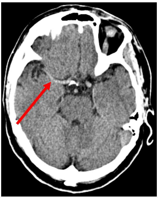 <p>What is shown in this native CT aspect image?</p>