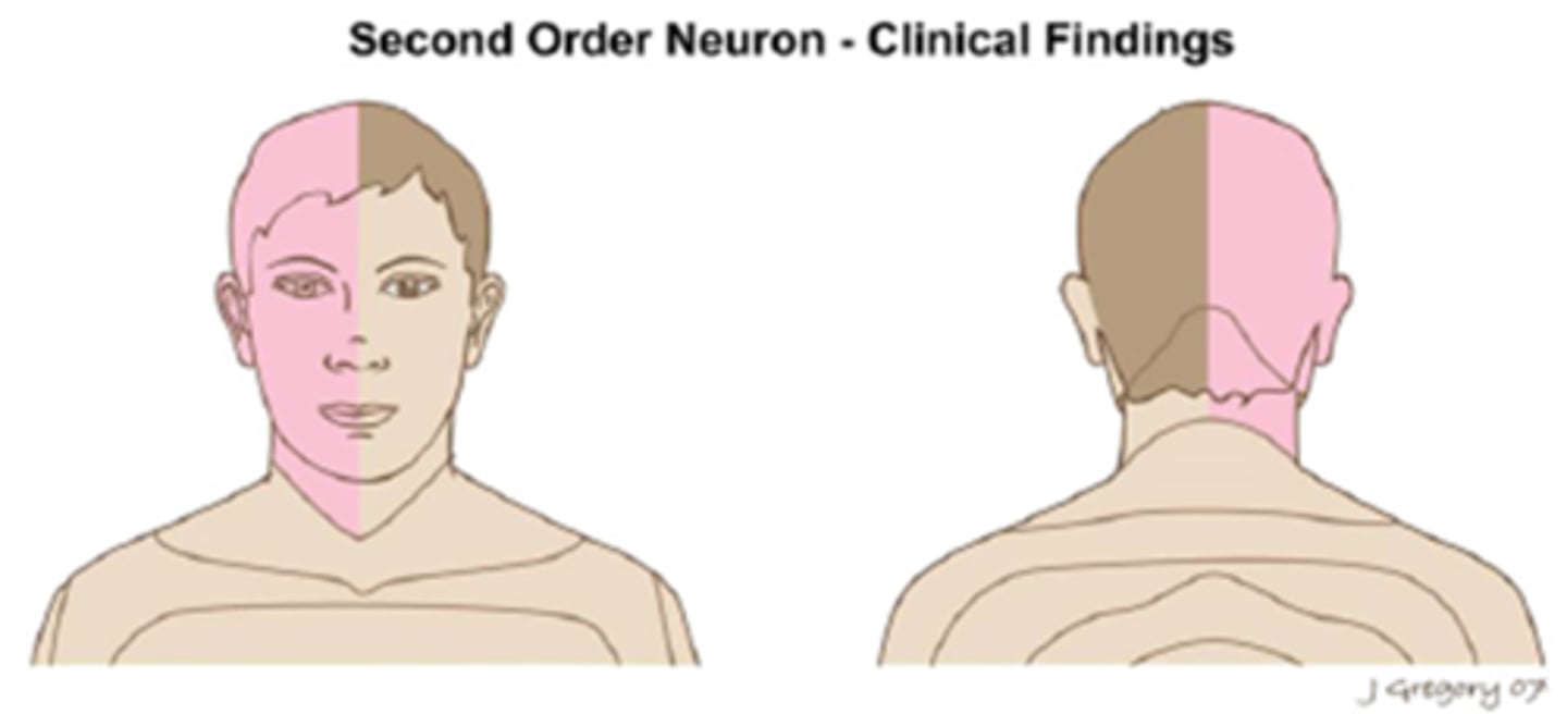<p>ipsilateral anyhydrosis of the entire face </p><p>if high enough to be in spinal cord = upper body anydrosis</p><p>if high enough to be in brainstem = entire body anyhydrosis</p>
