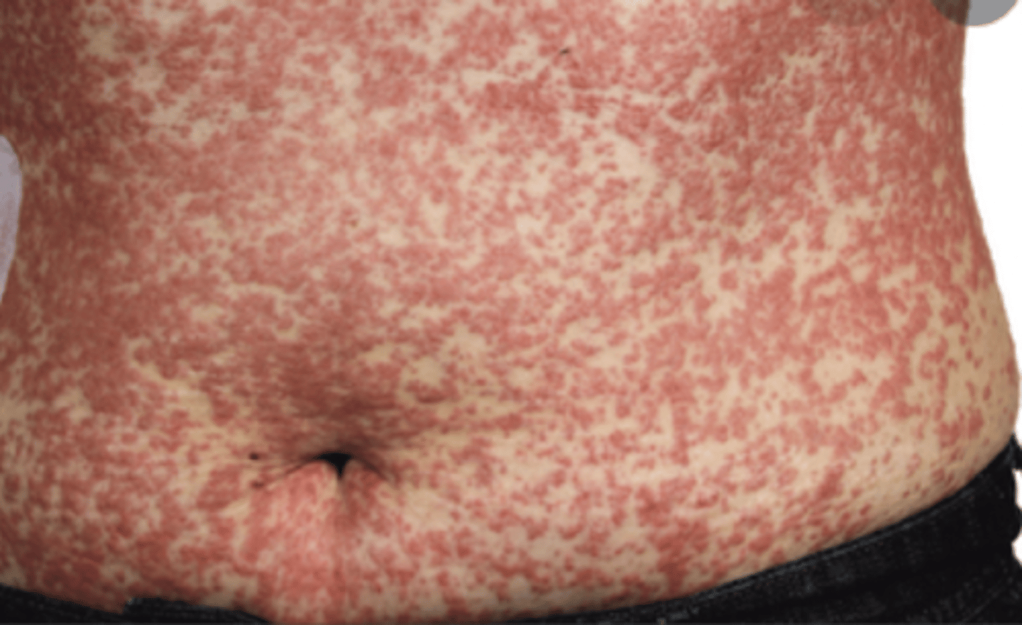 <p>exanthematous eruption AND eosinophilia, fever, lymphadenopathy, and multiorgan involvement</p>