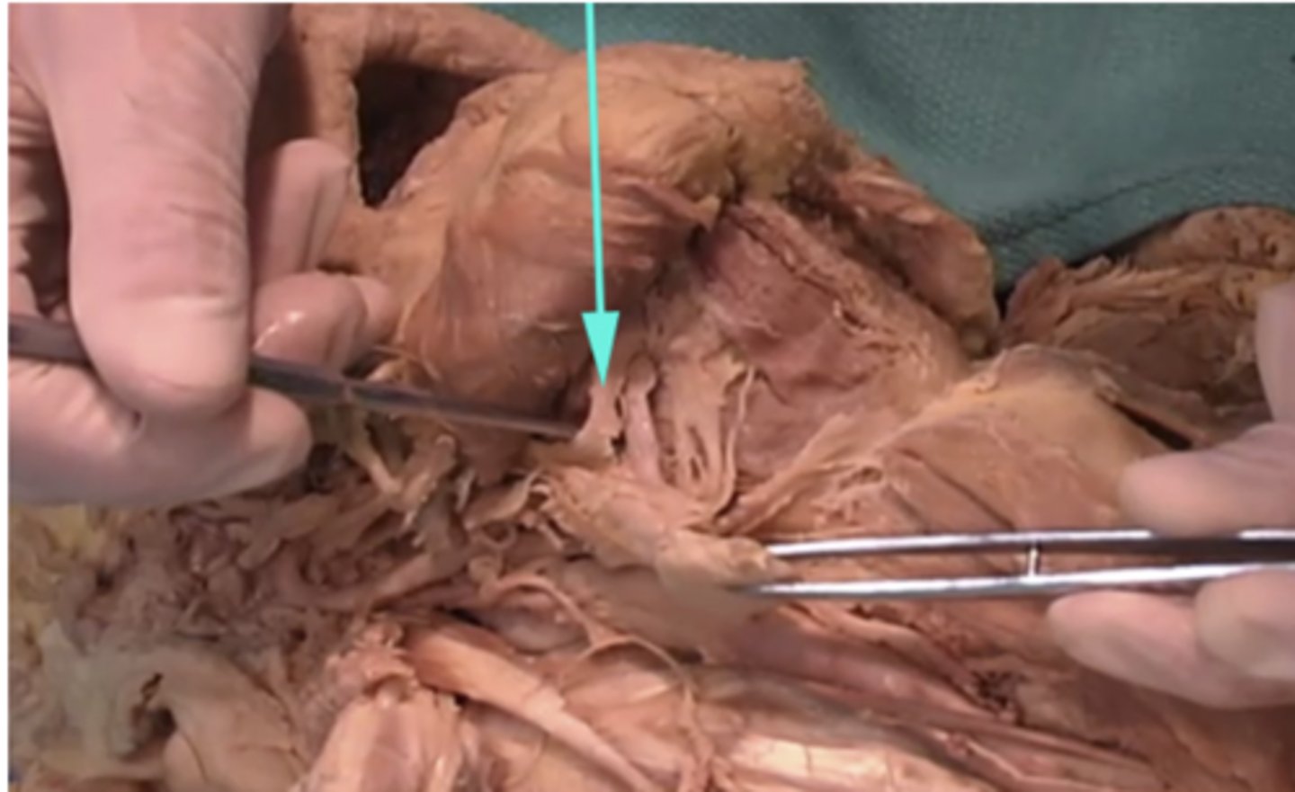 <p>What is the name of the structure as indicated by the arrow?</p><p>-Cranial nerve IX (9)</p><p>-Hyoid</p><p>-Cranium vein</p><p>-Lingual nerve</p>