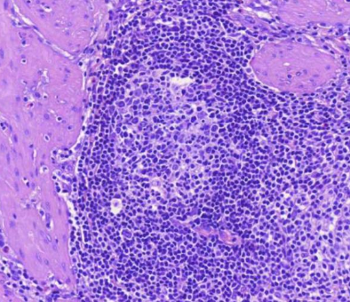 <p><strong><u>MIKÄ TAUTI?</u></strong> lymfaattiset solut muodostavat paikoin reaktiokeskuksia</p>