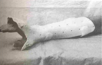 <p>Name this static splint component. What’s its function?</p>