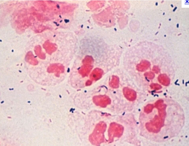 <p>STI caused by chlamydia trachomatis</p><p><u>Complications </u>(F): pelvic inflammatory disease causing infertility and ectopic pregnancy</p><p><u>Signs </u>(mostly asymptomatic):</p><ul><li><p>Painful ejaculation (M) and intercourse</p></li><li><p>Clear, mucoid penila/ vaginal discharge</p></li><li><p>Testicular swelling (F)</p></li><li><p>Bleeding between periods (M)</p></li></ul><p><u>Diagnosis</u>:</p><ul><li><p>Nucleic acid amplification test (NAAT)</p></li><li><p>Culture of first pass urine samples or swabs: gram -ve, ovoid shape </p></li></ul><p><u>Treatment</u>:</p><ul><li><p>Azithromycin 1g once OR</p></li><li><p>Doxycycline 100mg orally 2/ day for 7 days</p></li></ul><p></p><p></p>