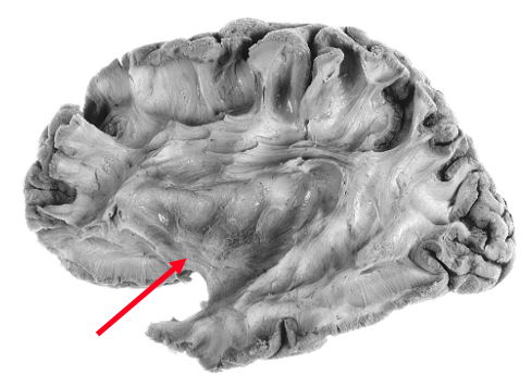 <p>which cerebral fiber pathway </p>
