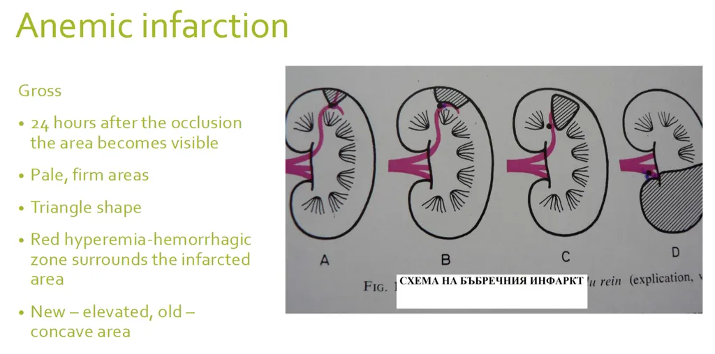 <p><strong><span>Indicate the correct statement(s) for anemic infarction</span></strong>. (2)</p><p><strong>a) the term is synonym of white infarction </strong></p><p>b) the term is synonym of red infarction </p><p><strong>c) it develops as a result of absolute ischemia after total obstruction of an “end-type artery” </strong></p><p>d) it mainly affects the lungs and liver</p>