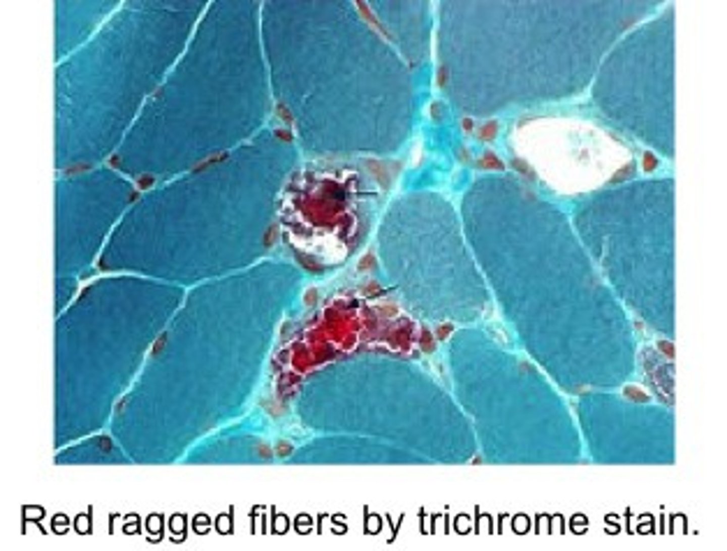 <p>Myoclonic Epilepsy with Ragged Red Fibers</p><p>Caused by point mutation to mitochondrial tRNA tys, results in clumps of diseased mitochondria aggregating in muscle tissue, causing red clumps</p><p>Since mitochondria can not produce ATP, the nervous system and muscles are immediately implicated because they have the highest ATP requirements</p>