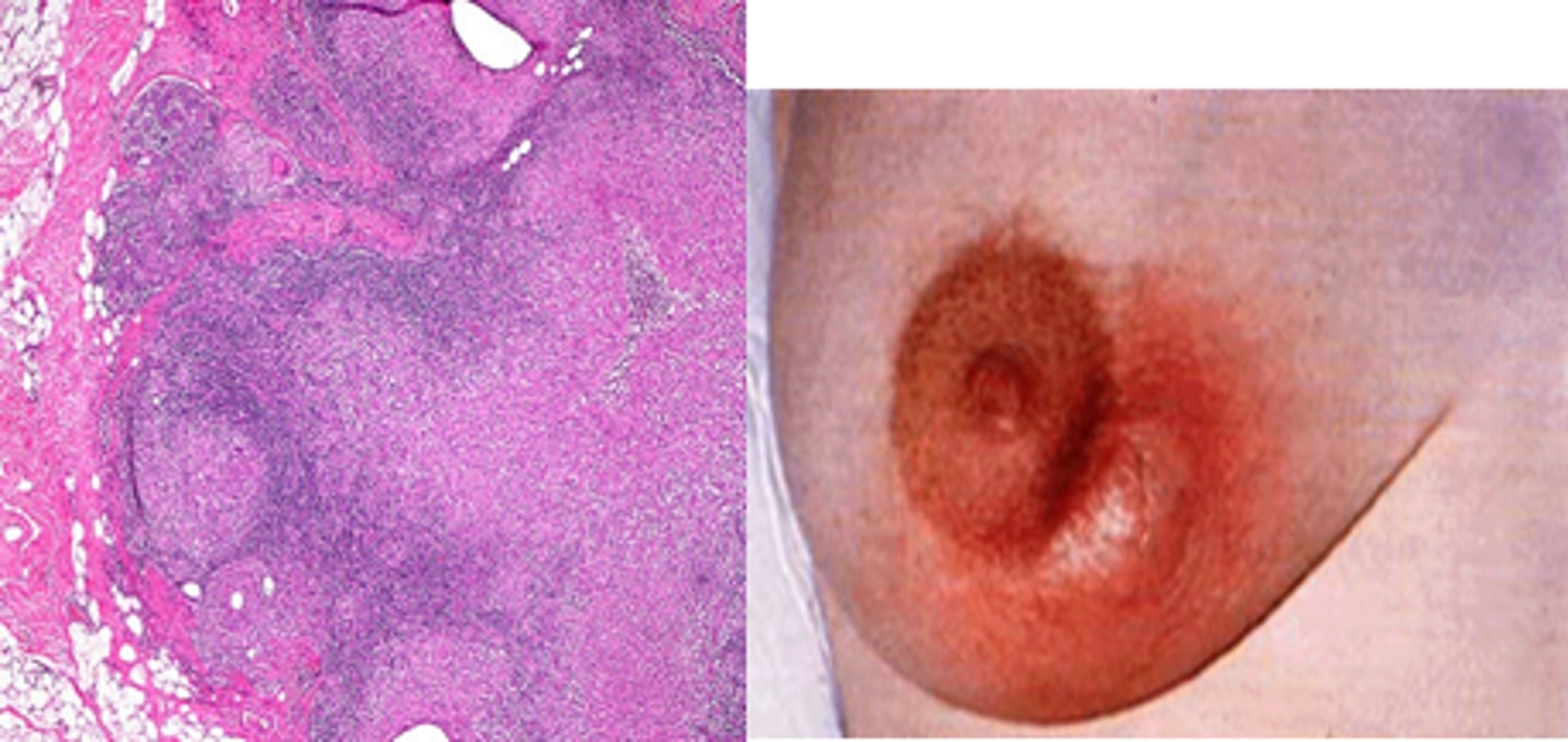 <p>Define Condition:</p><p>Bacterial Infex while breastfeeding</p><p>-Path: MCC = S. aureus via fissures and cracks in nipples</p><p>-Sx/PE:</p><p>&gt; Red, swollen, painful breast</p><p>&gt; FEVER</p><p>&gt; Malaise</p><p>-Tx: Uncomplicated = Abx &amp; Breastfeed (helps prevent milk stasis)</p><p>-Prog: Complication --&gt; Abscess</p>