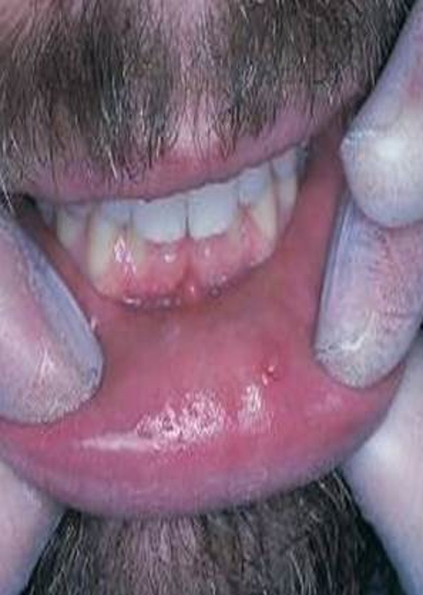 <p>Mucous Retention Lesion: Mucocele</p>