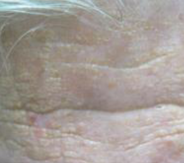 <p>yellowish white macules on sun-exposed skin, especially forehead</p>
