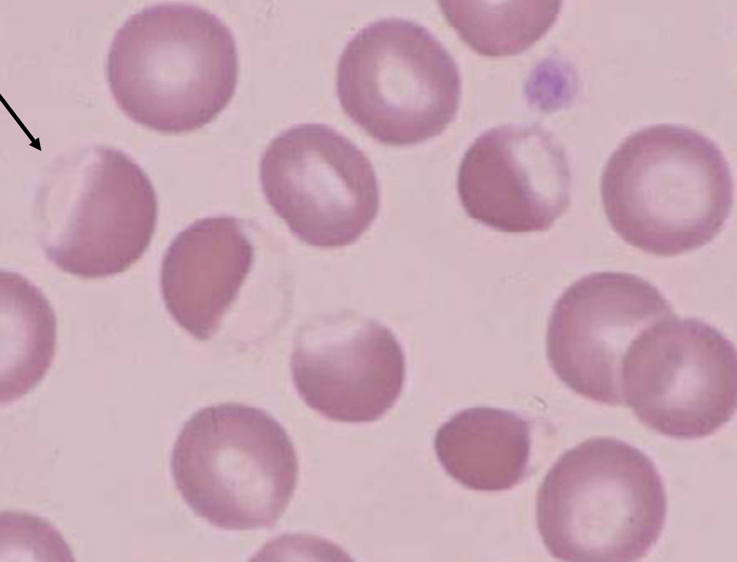 <ul><li><p>RBCs with hemoglobin shifted to one side of the cell</p></li><li><p>on the other side, there is a clear area and a thin membrane</p></li><li><p>indicates <strong>oxidative membrane damage</strong></p></li></ul><p></p>