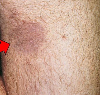 <p>What population are more at risk of having Kaposi Sarcoma?</p>