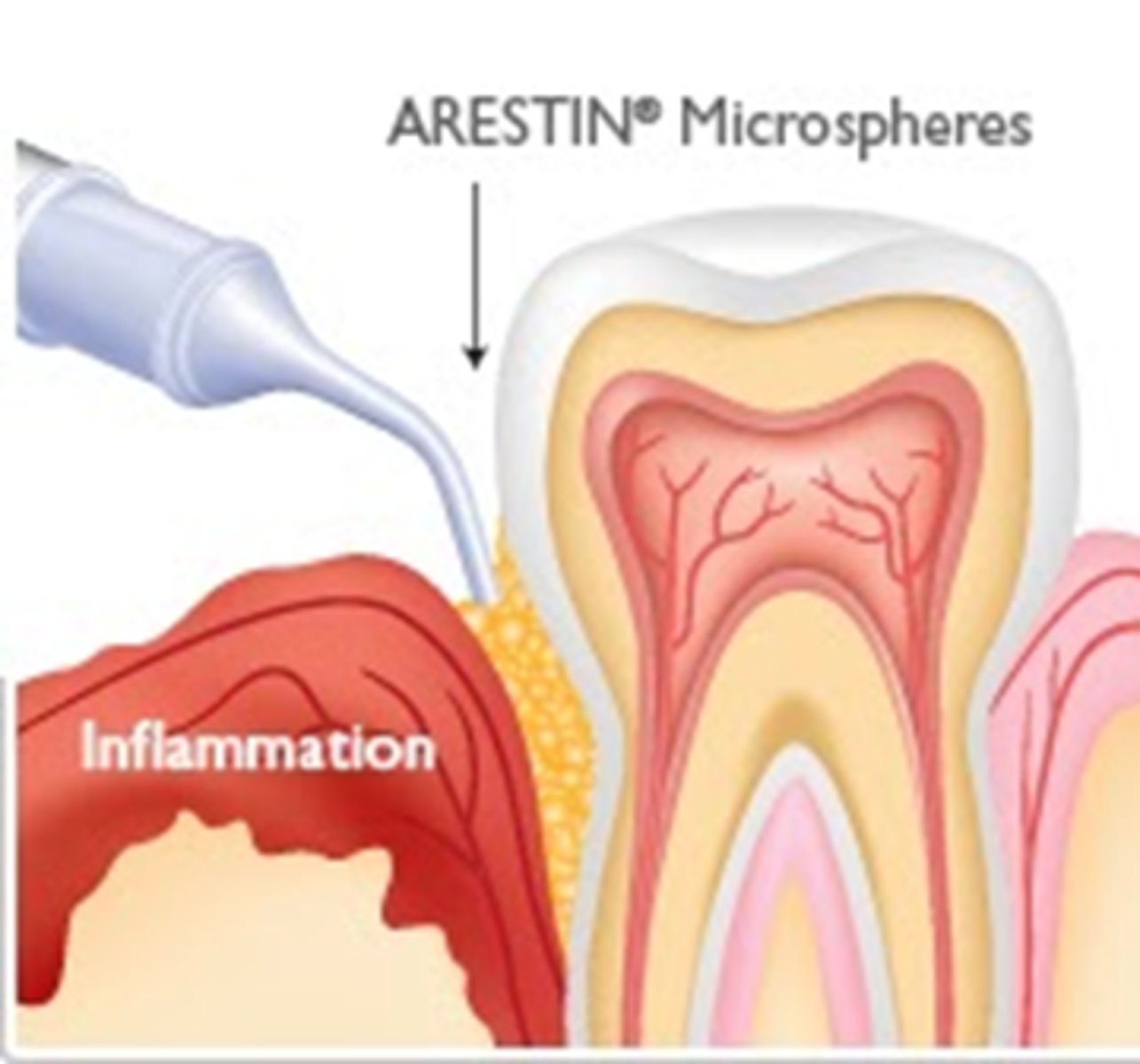 <p>a controlled release mechanism -- brand name Arestin</p>