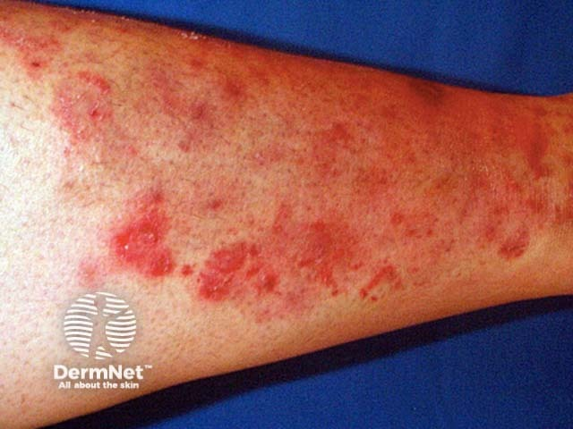 <p>PP: potent topical/non-antifungal steroid→drives fungus deep into skin→affects hair follicles</p><p>E: dermatophytes</p><p>CM: irregular/red/scaly plaque<br>follicular papules<br>pustules→more severe→majocchi’s granuloma</p><p>TX: PO griseofulvin x 4-6 weeks</p>