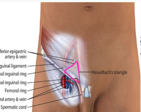<p><strong>Hesselbach’s Triangle (Inguinal Triangle)</strong></p><p>-Location of direct inguinal hernias </p><p>-Lateral border → inferior __________ vessels</p><p>-Medial border → lateral edge of _______ ________</p><p>-Inferior border → ________ ligament (lacunar portion)</p>